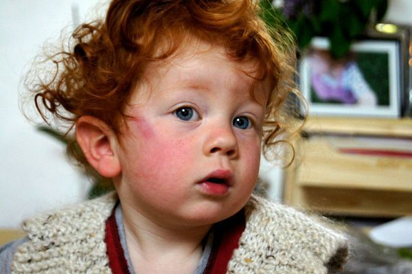 Plazmolifting de la pigmentation de la personne les rappels