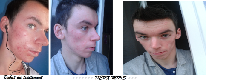 Roaccutane avis femme : Clomid taux grossesse Roaccutane avis femme : Clomid taux grossesse