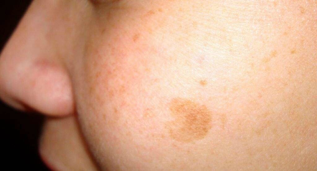 La pigmentation de la peau de la poitrine et le dos