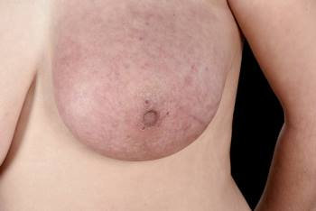 c0333618-breast-cancer-science-photo-library-high_fr
