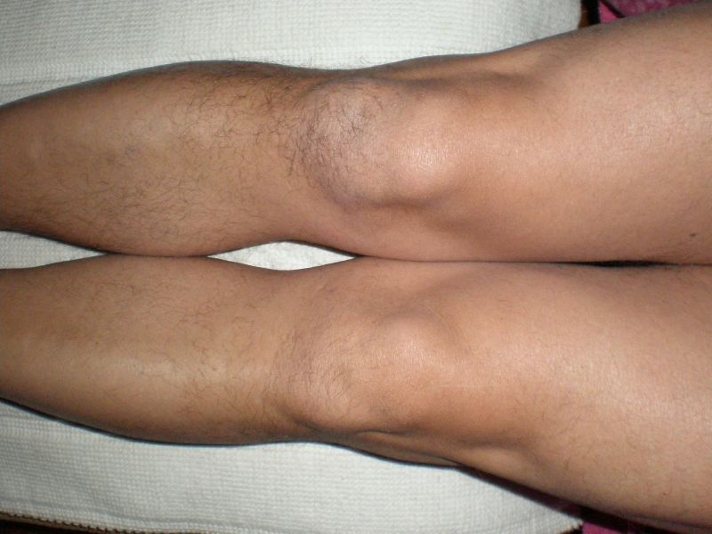 lésion d'un ménisque du genou et son arthroscopie